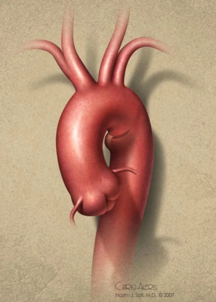 Medical illustration of the thoracic aorta and aortic arch.